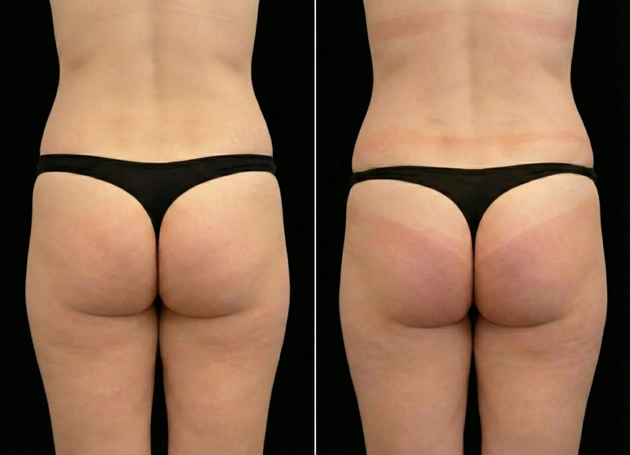 Emsculpt Neo effect on buttocks