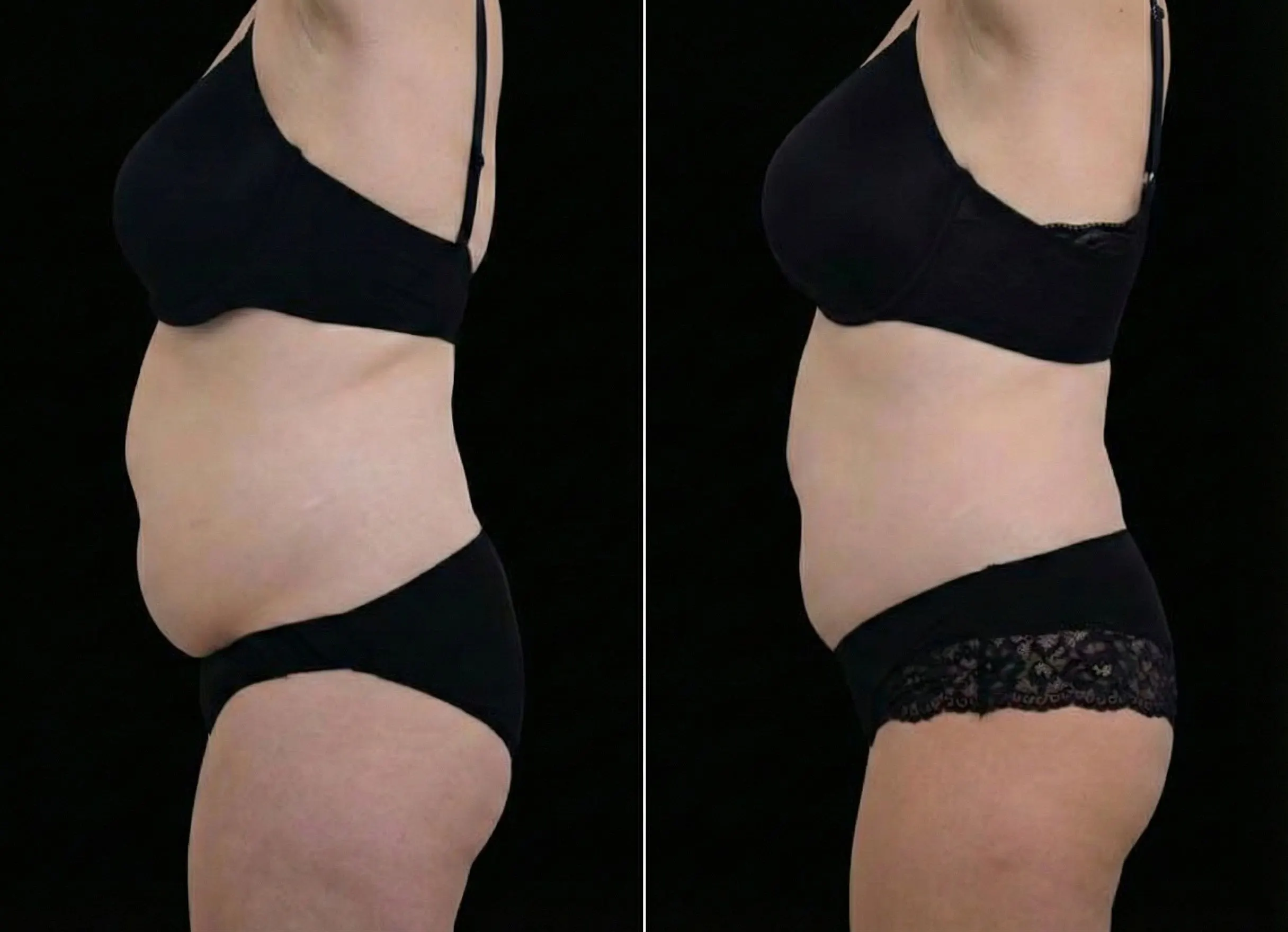 Emsculpt Neo effect on the stomach